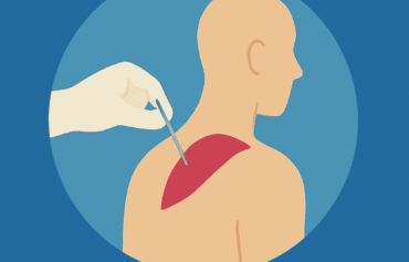 Dry Needling