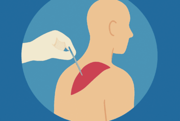 Dry Needling