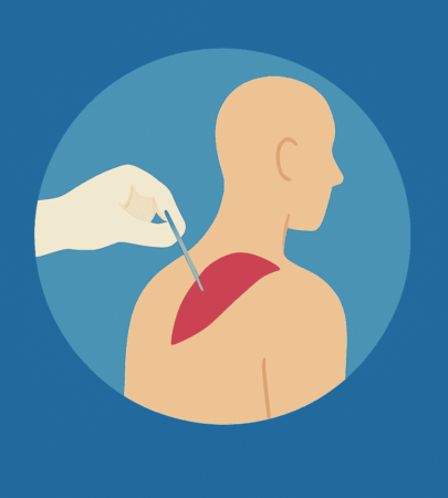 Dry Needling